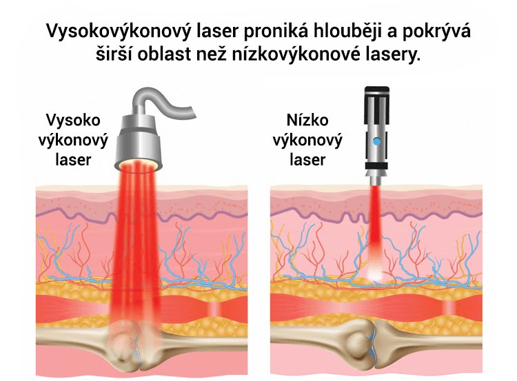 Informační diagram porovnávající vysokoúčinný laser, který proniká hlouběji, s nízkoúčinným laserem, s důrazem na léčebné efekty na kůži a tkáně.